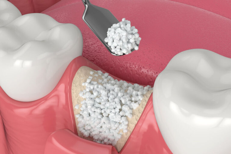 3D render of dental bone grafting with bone biomaterial application