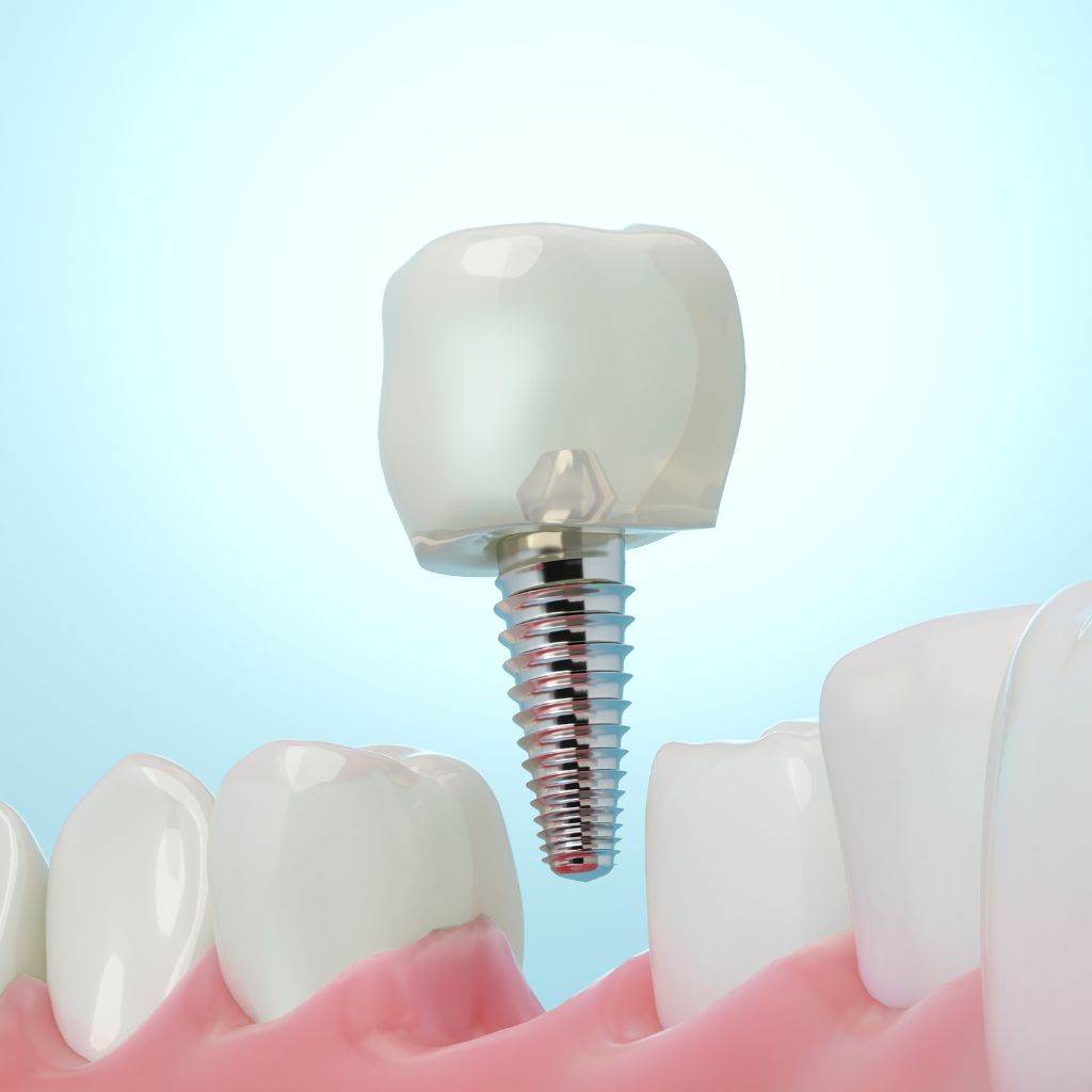 a single dental implant