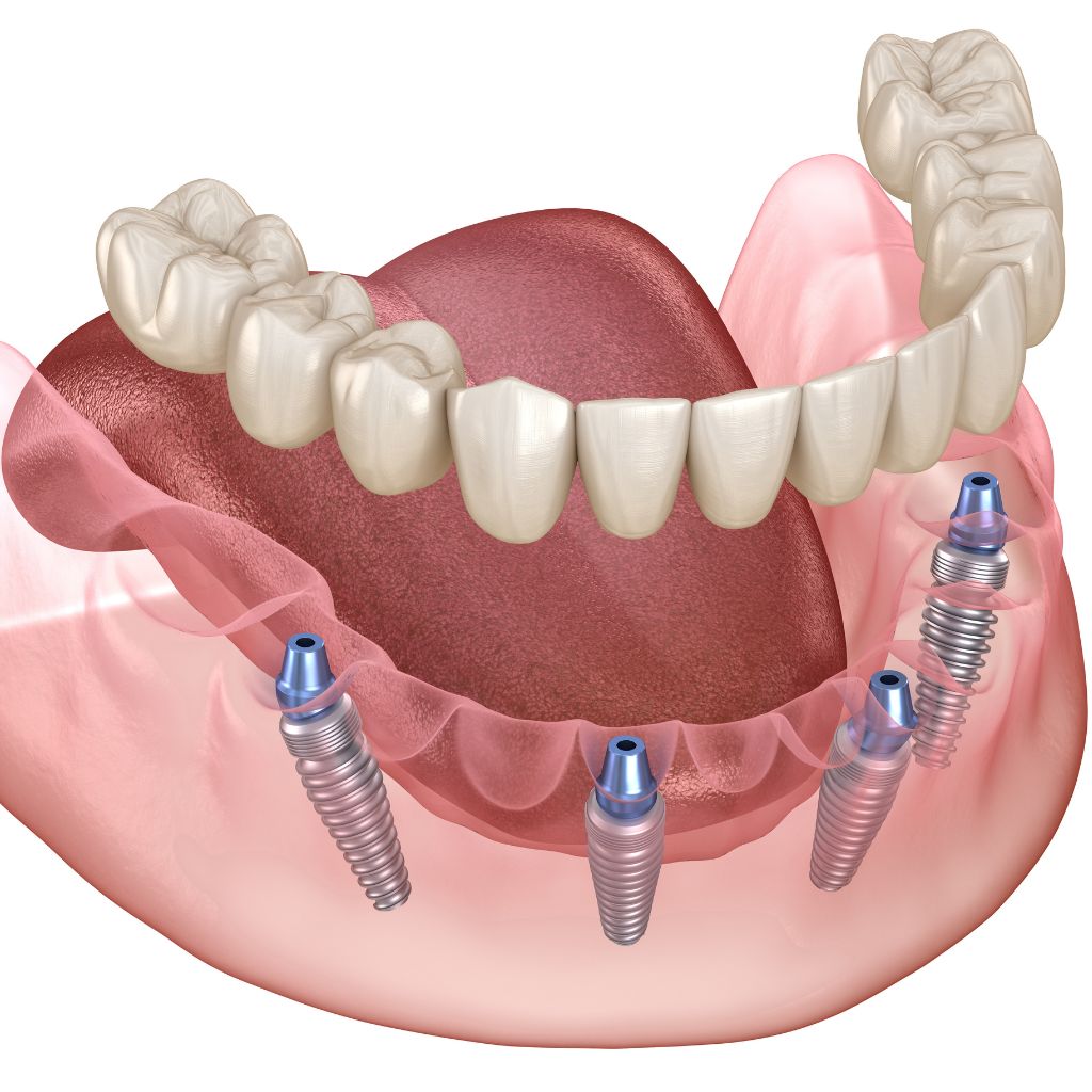 allon4 dental implants