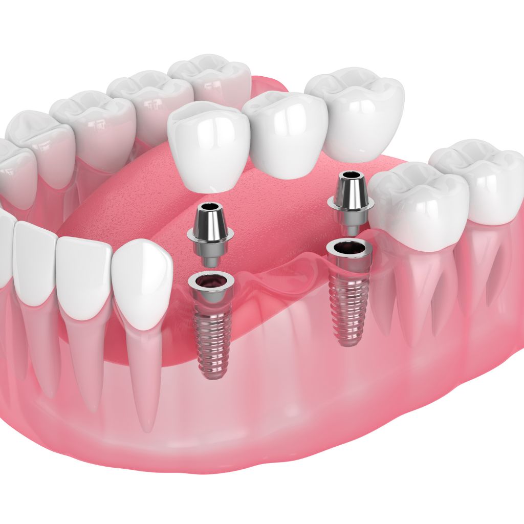 multiple dental implants