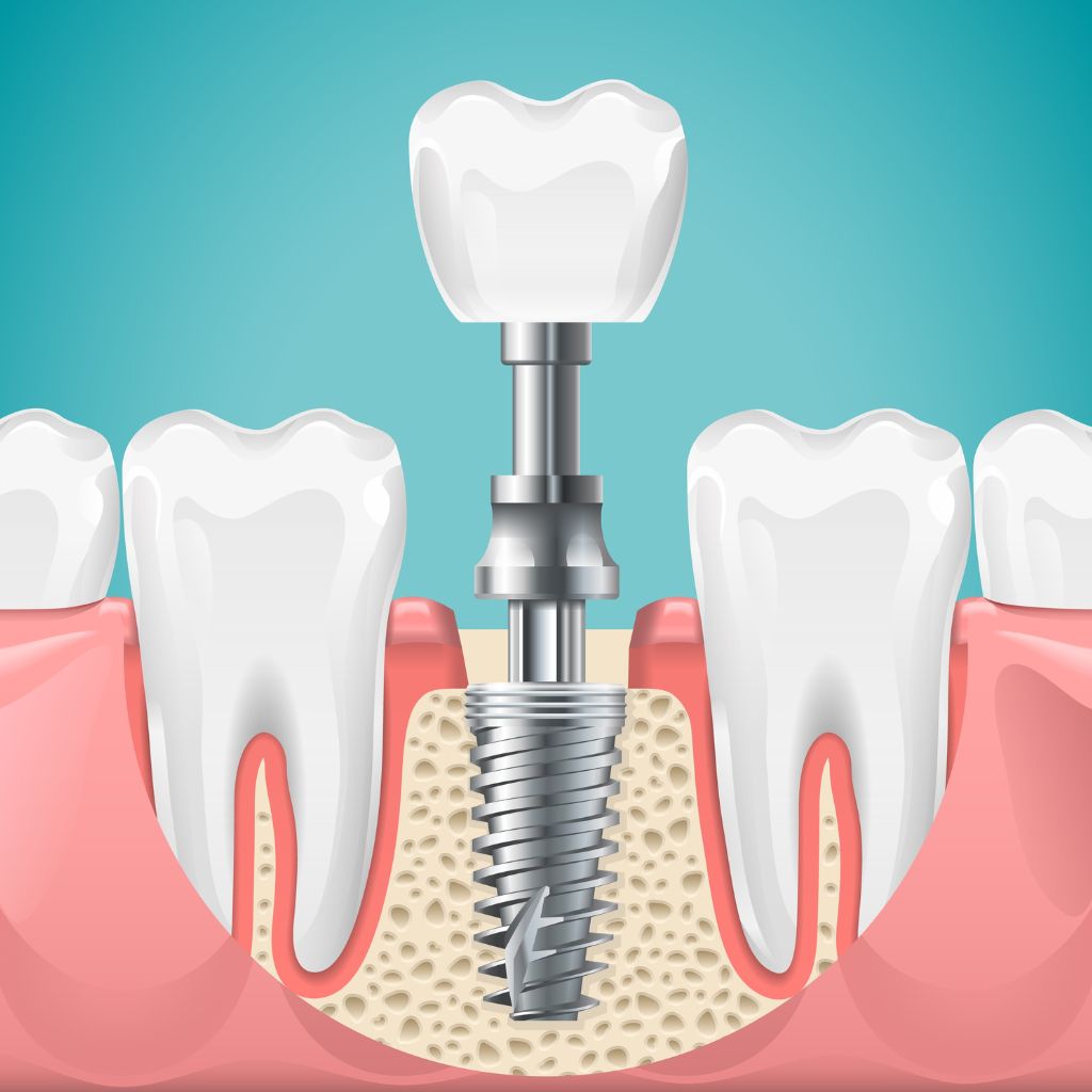 placing in dental implant